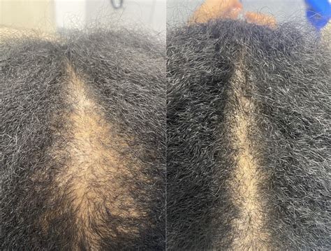 Hair Restoration Near Me | Cedar Park, TX | AustinMD Clinic