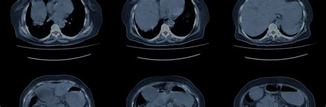 Tomografía de abdomen y pelvis.