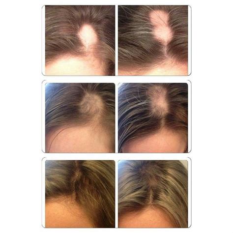 Amazing regrowth from alopecia using monat😍 | Monat hair, Monat hair growth, Thining hair