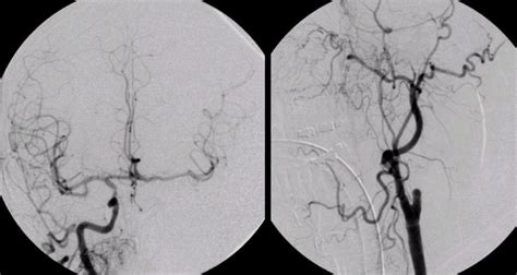 Internal Carotid Artery9