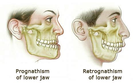 Orthognathic surgery | Studio Dentaire