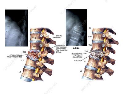 Compression fracture of thoracic vertebra - Stock Image - C021/0261 ...