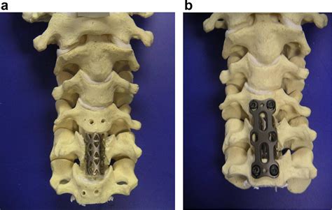 Corpectomy with titanium cage reconstruction in the cervical spine ...