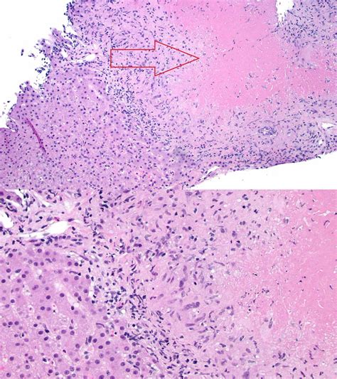 Cureus | A Rare Case of Necrotizing Sarcoid Granulomatosis Involving Liver