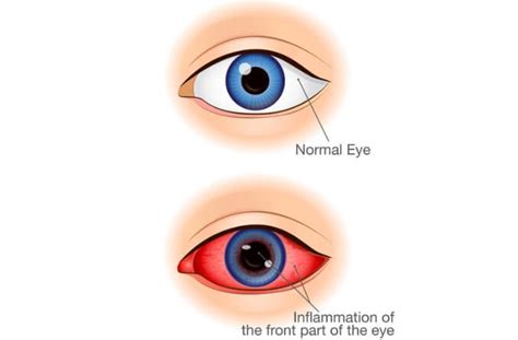 Anterior Uveitis: Symptoms, Treatment and More