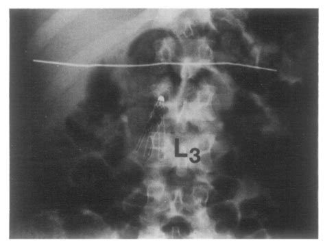 Abdominal radiograph (case 2) after insertion of Greenfield filter. | Download Scientific Diagram