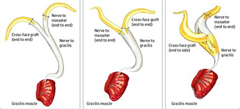 Neurorrhaphy Techniques | Download Scientific Diagram