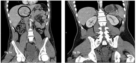 A grade 1 liver laceration (a) highlighted in the solid black circle... | Download Scientific ...