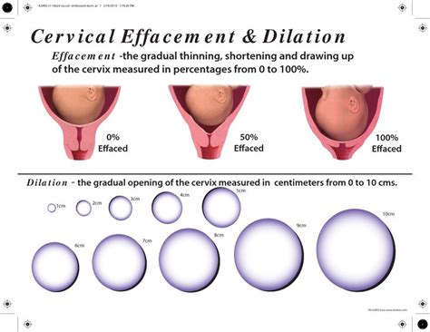 Cervical Effacement Dilation | Cervical effacement, Cervix dilation, Cervix