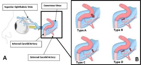 Carotid Cavernous Fistula