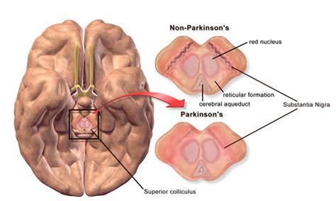 Welche Symptome führen zur Parkinson-Diagnose? - Wie-funktioniert.com