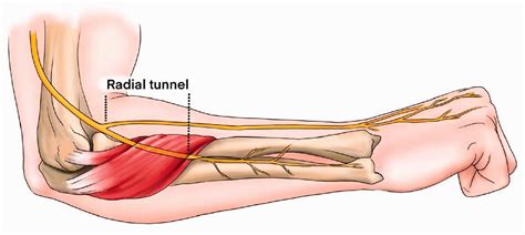 Radial Tunnel Syndrome - Physioflow PT | Physical Therapy | Vancouver, WA