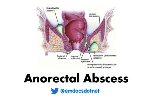 emDOCs.net – Emergency Medicine EducationAnorectal Abscesses: ED Clinical Presentation ...