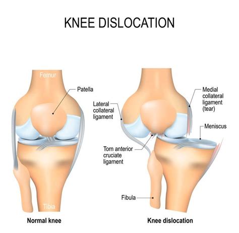 Patellar Subluxation Subluxed Partially Dislocated Kneecap Facts | atelier-yuwa.ciao.jp