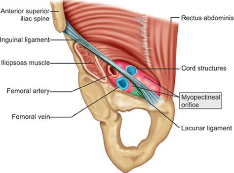 Iliopubic Tract Vs Inguinal Ligament