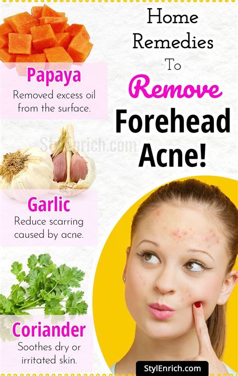 Home Remedies to Remove Forehead Acne | Forehead acne, Skin care acne, Acne remedies