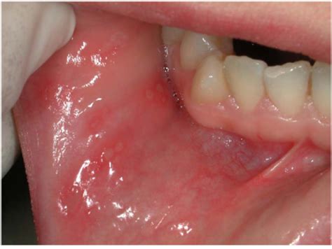 Several RAS on buccal mucosa in a CD patient. | Open-i