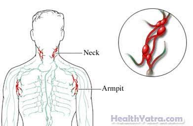 Chronic Lymphadenitis Definition, Causes, Symptoms, Complications and ...