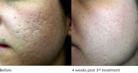 Acne Scar Removal Treatment Melbourne ALL Skin Types | 1300 896 834