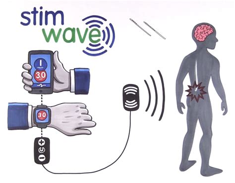 Stimwave Wireless SCS | Spinal cord stimulator, Bart simpson, Bart