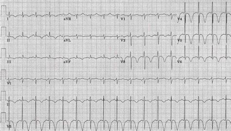 EKG abnormalities in central nervous system disease - wikidoc