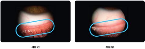 Xerophthalmia Definition Causes Symptoms Treatment