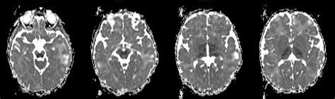 Stroke differential diagnosis and mimics: Part 1 • APPLIED RADIOLOGY