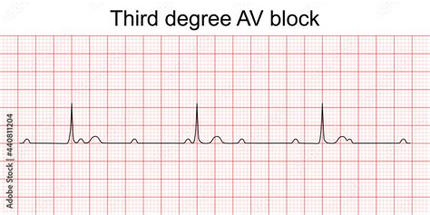 Electrocardiogram show third degree (complete) AV block pattern. ECG ...