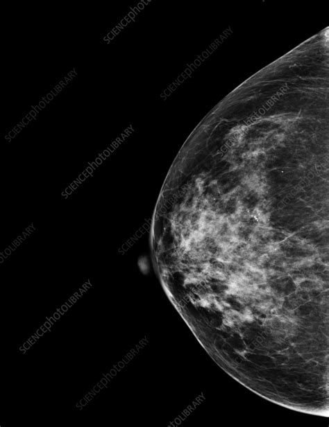 Normal mammogram - Stock Image - F037/3427 - Science Photo Library