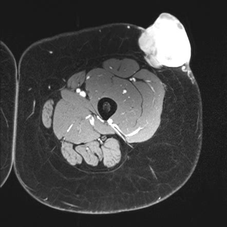 Dermatofibrosarcoma protuberans | Radiology Case | Radiopaedia.org