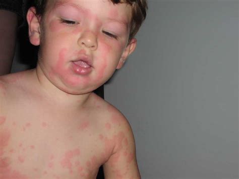 Pics of my son's HORRIBLE RASH: ever see this before? Any ideas?