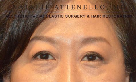 Beverly Hills Facelift Before and After Photos - Los Angeles Plastic ...