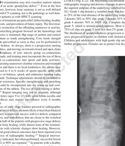 32. Bilateral pars defects with resultant grade 2 anterolisthesis of L5... | Download Scientific ...