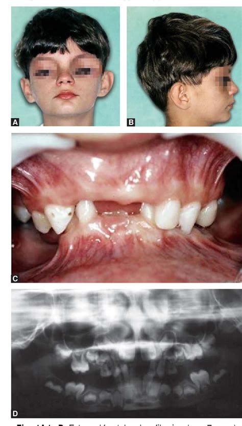 Figure 1 from Aarskog-Scott Syndrome: A Review and Case Report | Semantic Scholar