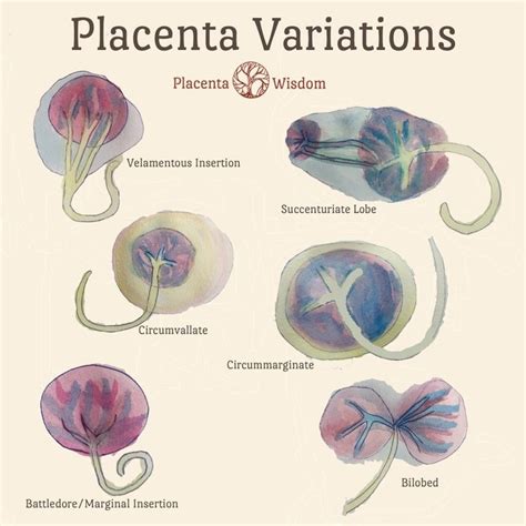 Placenta Variations | Student midwife, Placenta, Midwifery