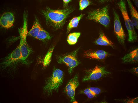 Use of Immunocytochemistry in Cytopathology – Yosemite Pathology ...