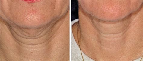 thermage Neck before and after - thermage before and after