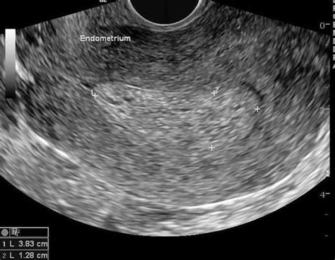 Abnormalities of the Endometrium. - | Endometrial hyperplasia ...