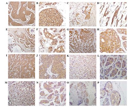 Expression profile of cathepsins indicates the potential of cathepsins B and D as prognostic ...