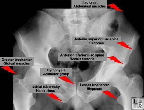 Learning Radiology - avulsion, lesser, trochanter, iliopsoas, psoas, iliacus, pelvic, fracture ...