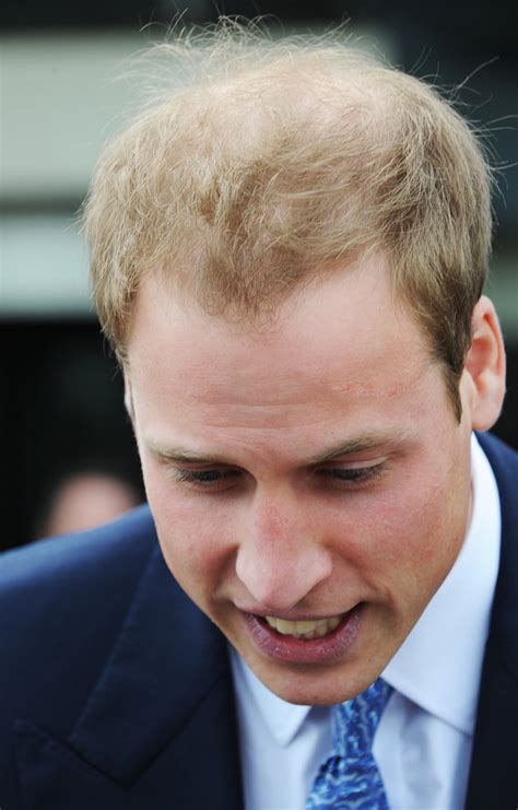 Prince Harry hair loss: Pics show royal will soon be as bald as brother Prince William - Daily Star