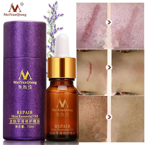 Scar Repair Skin Essential Oil Lavender Essence Skin Care Natural Pure Remove Ance Burn Strentch ...