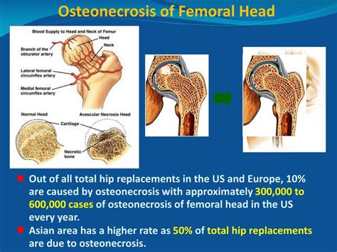 PPT - Clinical Evaluation of A Novel Reconstruction Device for Osteonecrotic Femoral Head ...