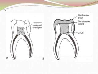 Pulpectomy With MTA Dental Care, 50% OFF