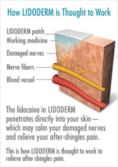 What Is Lidoderm Patch Side Effects - barterpiratebay