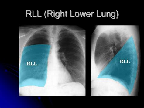 PPT - Chest Radiography Interpretation PowerPoint Presentation, free download - ID:3652162