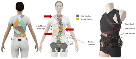 Scoliosis Brace