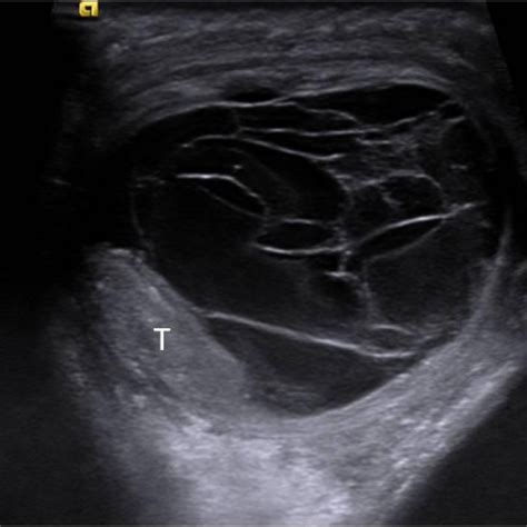 Idiopathic infant pyocele | Eurorad