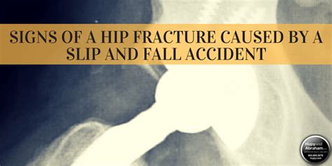 Slip and Fall Hip Fracture Symptoms and Recoveries | Hupy and Abraham, S.C.