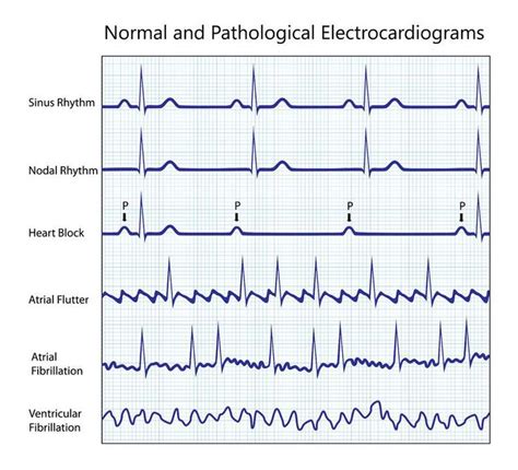 Atrial Flutter - Cardiology - Highland Hospital - University of Rochester Medical Center ...